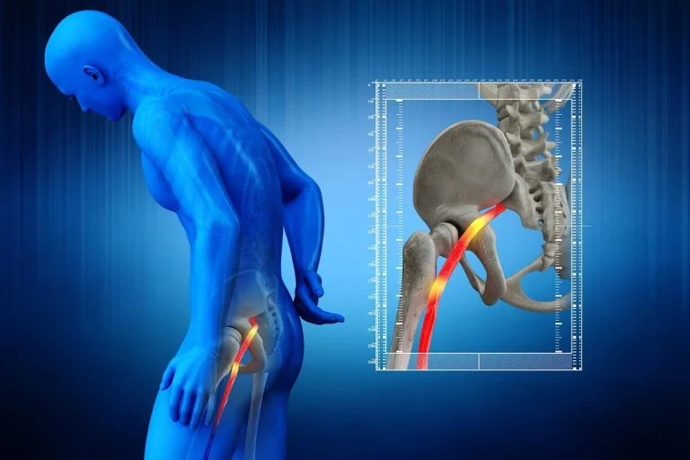What is Stage 4 Sciatica ?