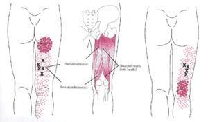 Sciatica Trigger Points Map: A Comprehensive Guide - MED CARE LINE