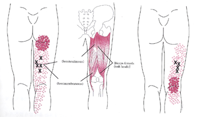 Scitica trigger points map