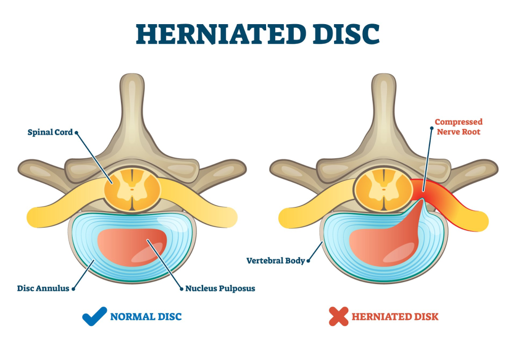 Dehydration and Herniated Disc leading to sciatica