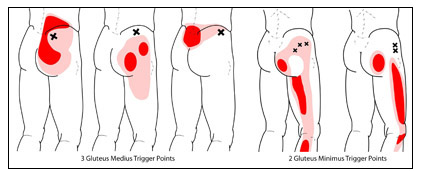 Dry Needling Trigger Points that help sciatica.