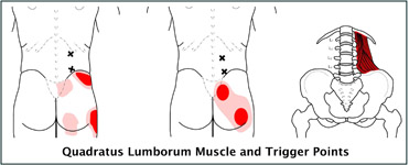 Scitica trigger points map