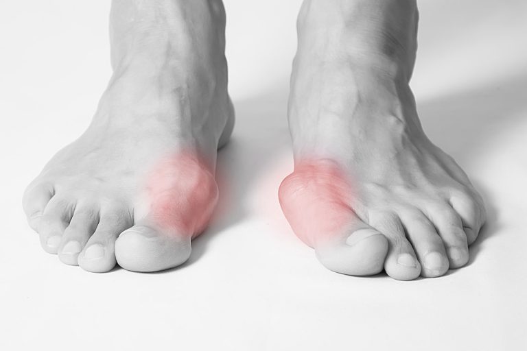 Can Bunions Cause Sciatica: A Comprehensive Analysis