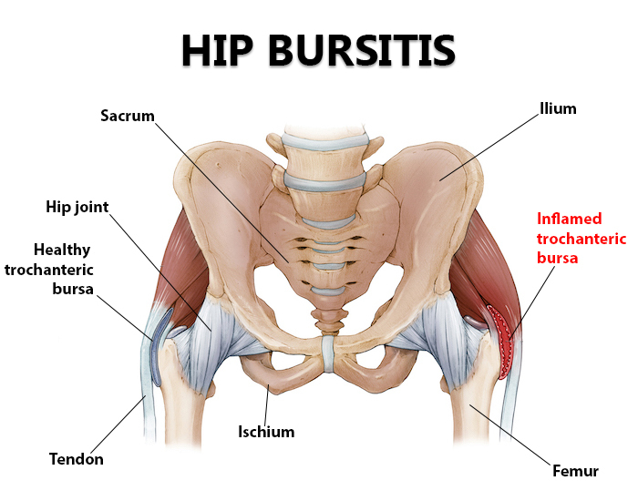Can Hip Bursitis Cause Sciatica