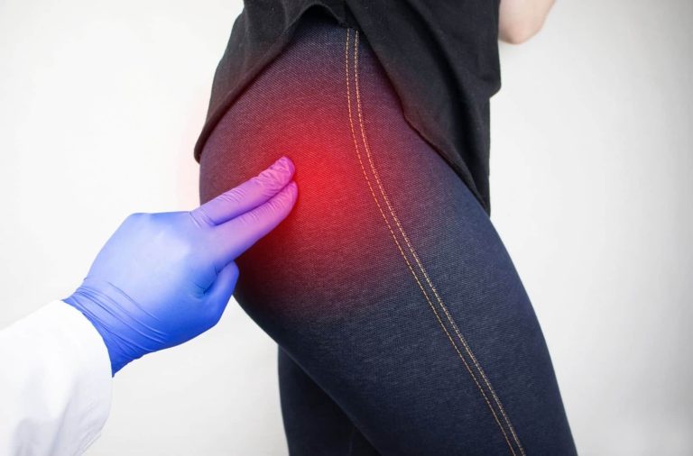 Can Hip Bursitis Cause Sciatica? Understanding the Connection