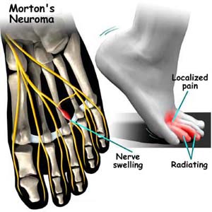 Morton neuroma