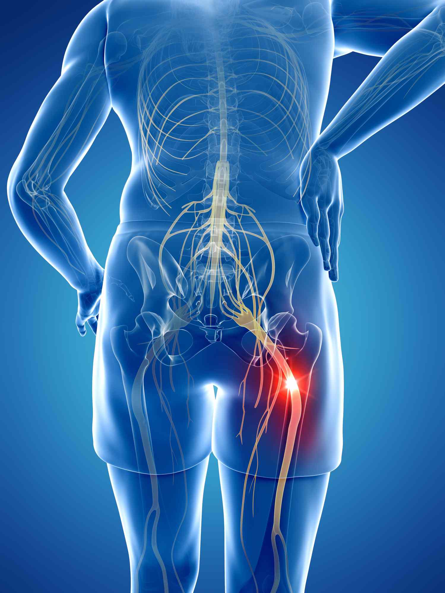 can MS cause sciatic nerve pain