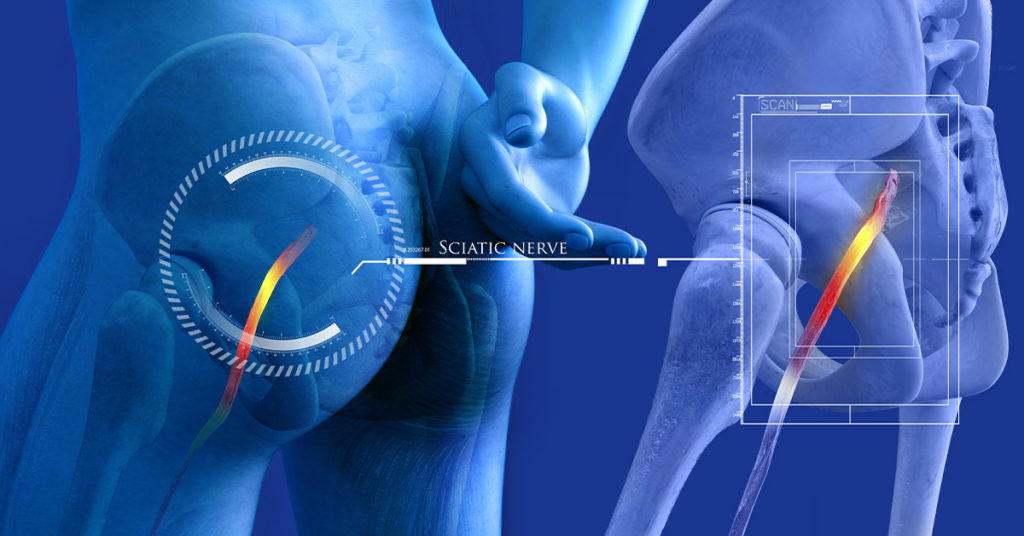 Will Hip Replacement Help Sciatica? A Comprehensive Analysis - MED CARE ...